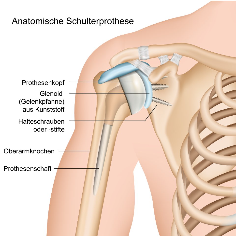 Anatomische Schulterprothese